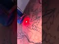 Лазерное удаление татуировки на аппарате More-Xel Dual Lumiere(Q-PTP)