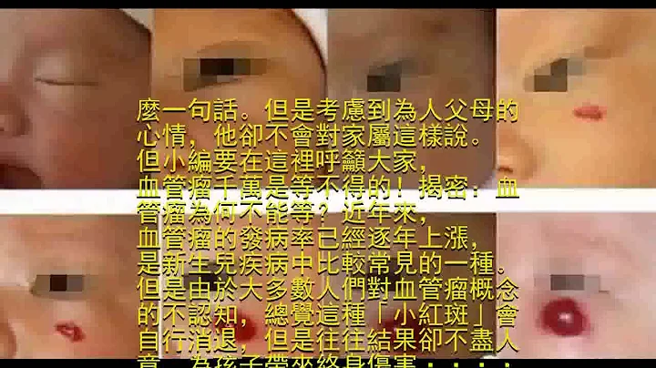 警示--等出来的血管瘤究竟有多可怕... - 天天要闻