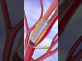 Laser Atherectomy (3D Animation) #laser #atherectomy #laseratherectomy #angioplasty #ballon #artery