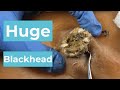 [ASMR] Sharp Ingrown Trimmed! Professional Pedicure DR LEE’S ULTIMATE ZITPOPPER 1210m5 6868