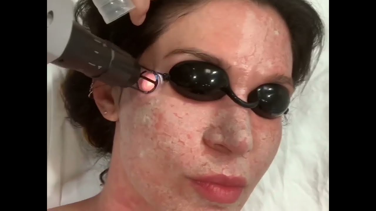 CO2 Fractional Laser - Cyprus Facial Surgery