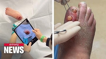 Bio-ink technology that helps regenerate bone tissues, then biodegrades in body