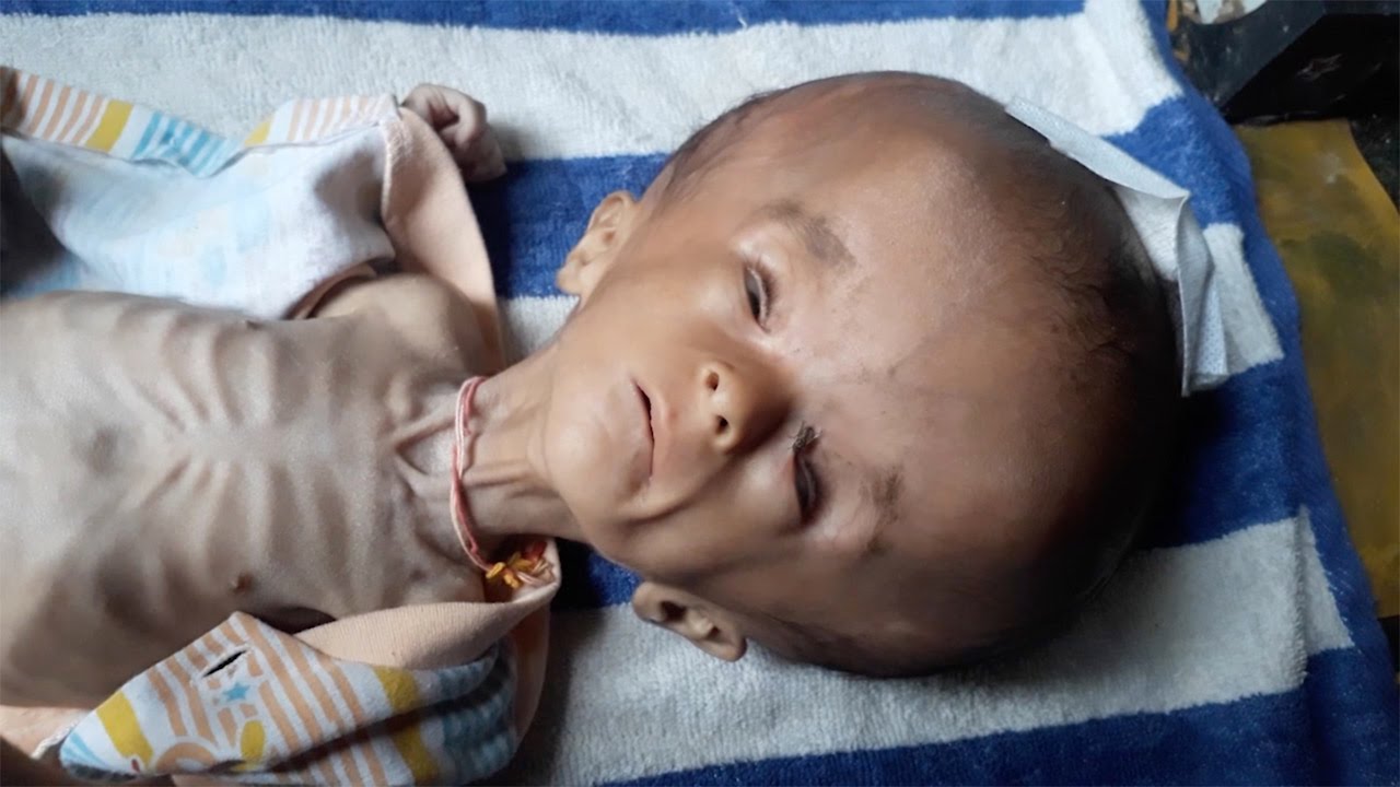 Baby With Football Sized Head - YouTube
