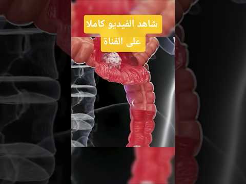 اكتشاف صادم بصمة جينية تفس ر سرطان القولون عند الشباب