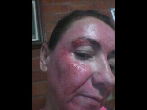 PRA QUE SERVE O DERMA ROLLER? - YouTube Rose Rose