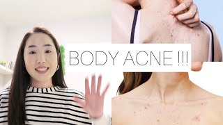 : ,     | #bacne treatments