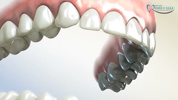 Niềng Răng Điều Trị Khớp Cắn Sâu Bằng Bẻ Dây Cung