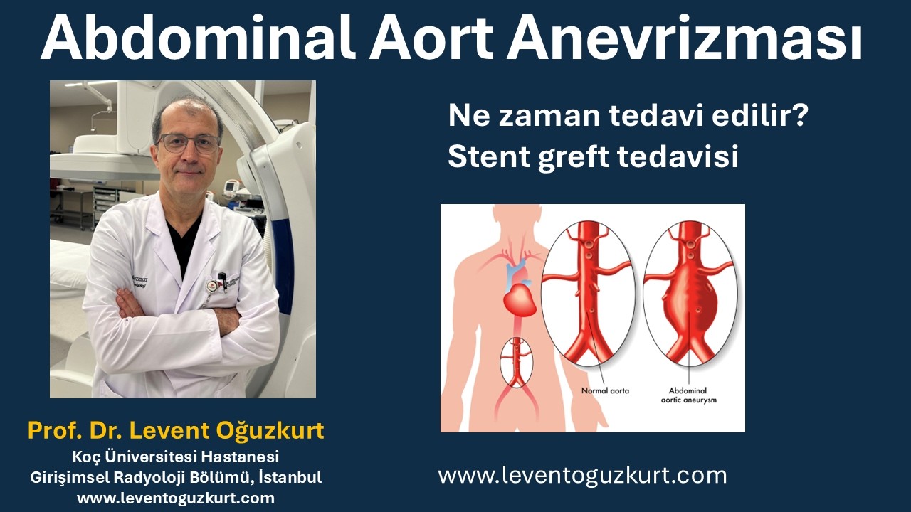 Abdominal aort anevrizması tedavisi (EVAR stent greft) bilgilendirme videosu - Prof. Dr. Levent Oğuzkurt