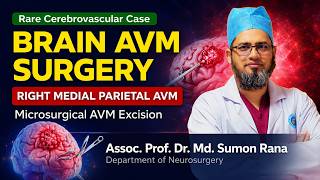 Right Medial Parietal Arteriovenous Malformation (AVM) Surgery | Neurosurgical Educational Video