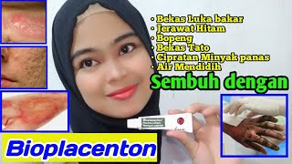 Bioplacenton's benefits in healing burn scars, acne scars, and pockmarks | Honest, proven review