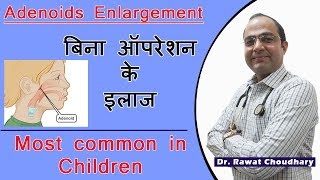 Adenoids Enlargement | Cure Without Operation | Most Common in Children screenshot 4