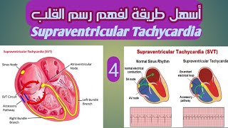 التسارع فوق البطينى SUPRAVENTRICULAR TACHYCARDIA, SVT رسم القلب الرجفة الأذينيه والتسارع فوق البطين