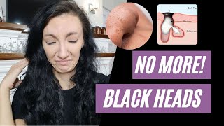 The BEST Blackhead Advice You Will Ever Get | How To Get Rid Of Them FOR GOOD