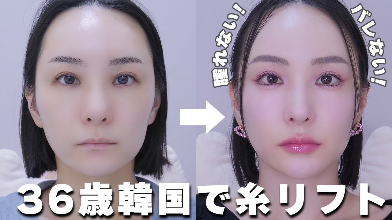30代糸リフト12本正直レビュー!! 韓国美容課金🇰🇷/リフトアップ/美容