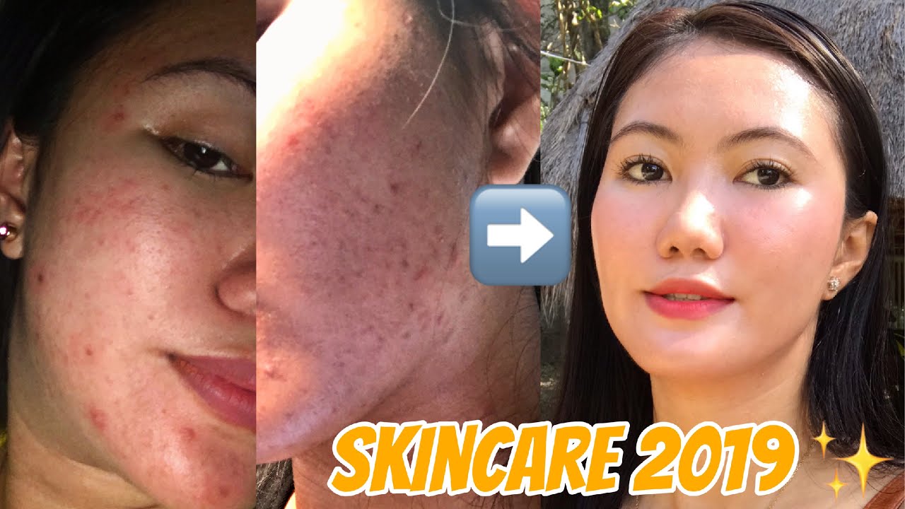 beautederm for pimple marks