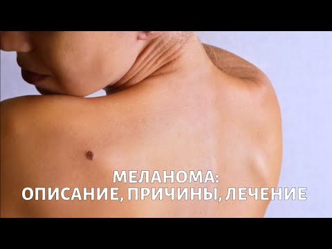 Меланома. Вопросы выживания