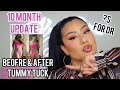 10 MONTH TUMMY TUCK POST OP UPDATE * SOME CONCERNS* Alma Rivera Beauty