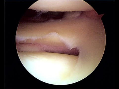 Повреждение мениска