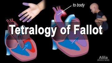 Congenital Heart Disease: Tetralogy of Fallot, Animation