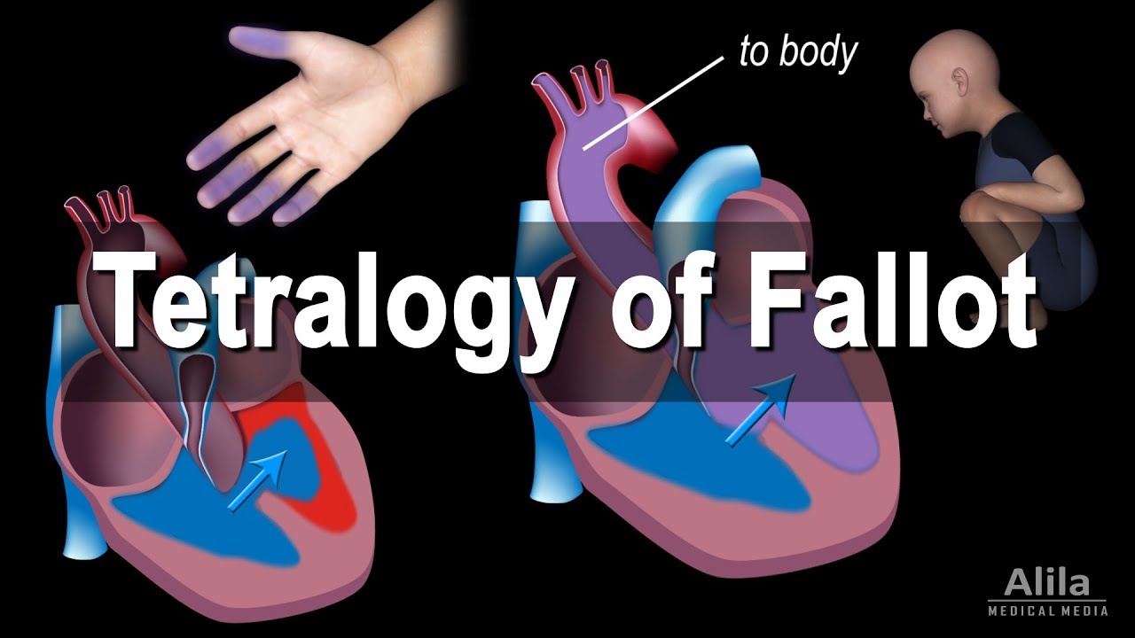 Congenital Heart Disease: Tetralogy of Fallot, Animation – Notadevs