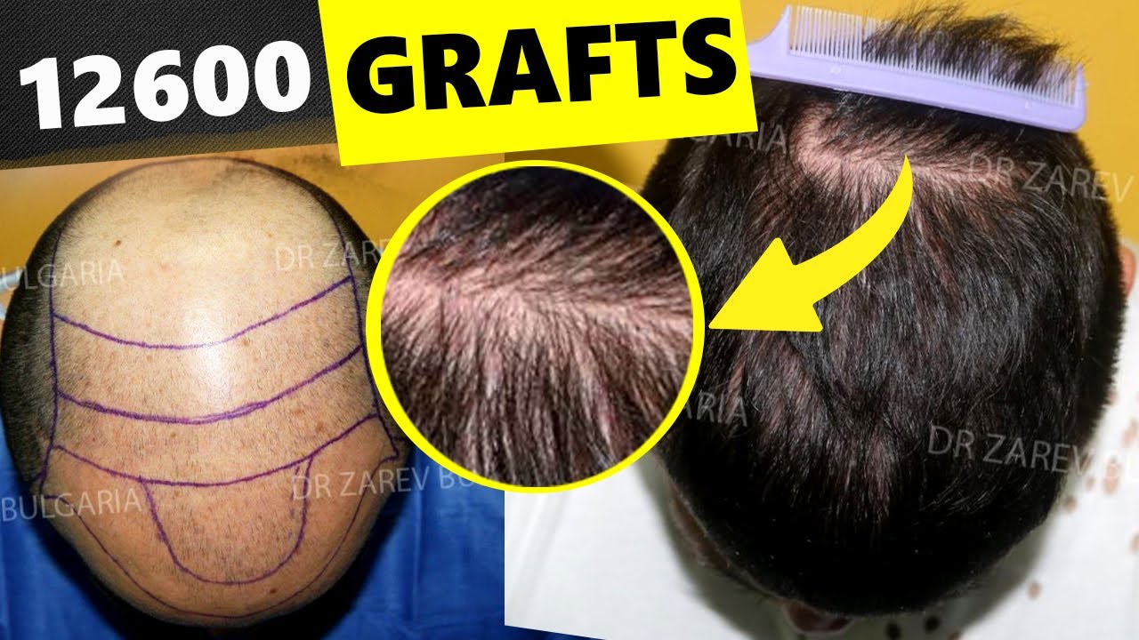 Доктор Зарев — Лучшие результаты FUE для NW 5 - NW 7