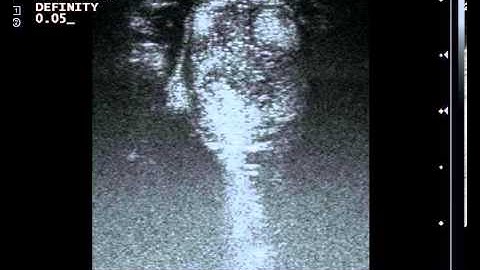 Movie 05 - Real-time visualization of flow dynamics inside a giant aneurysm during neurosurgery