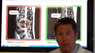Is Non Surgical Spinal Decompression effective for severely herniated discs?