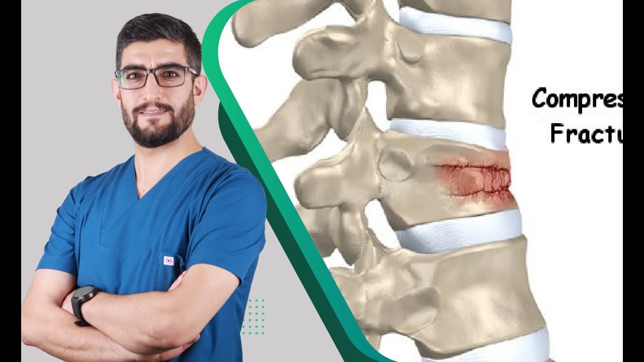 كسر الفقرات