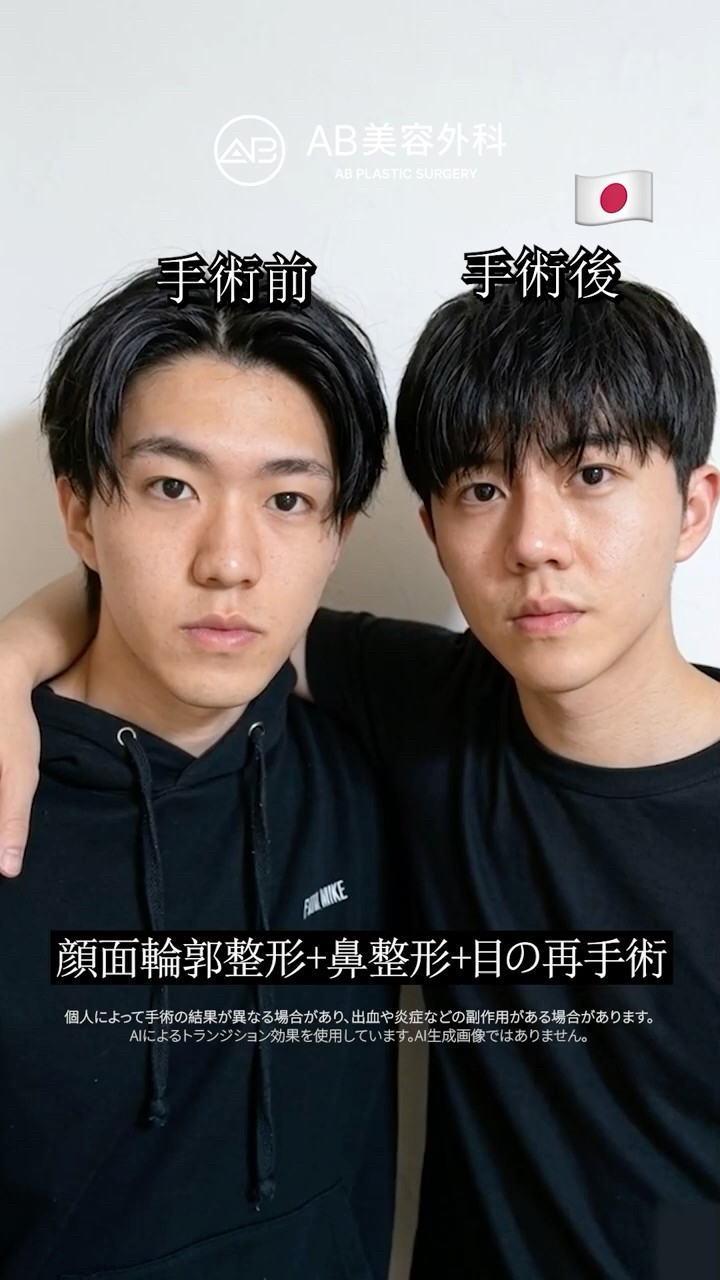 輪郭３点・目整形・鼻整形でここまで変化✨ #Shorts
