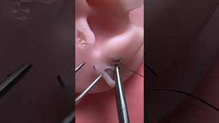 Earlobe Z-plasty repair (part 2)