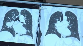 Cancer specialists in Florida see dramatic results with new clinical trial