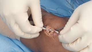 All-Onlay MPFL Reconstruction Using Double Knotless Knee FiberTak® Anchors
