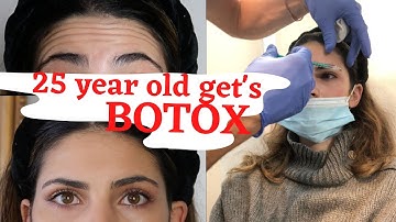 I DID BOTOX FOR THE FIRST TIME WITH 25 AND HERE