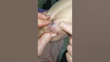Трихинеллы-2 trihocefallidae
