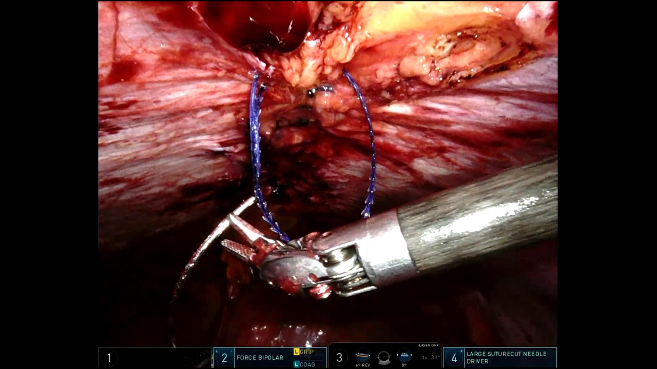 10x15 cm phasix st ventral hernia repair