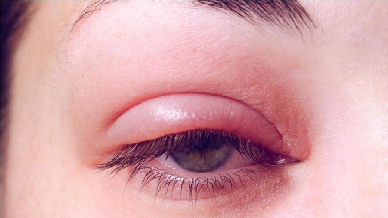 how to get rid of swollen eyes after crying TRY THIS NOW - YouTube