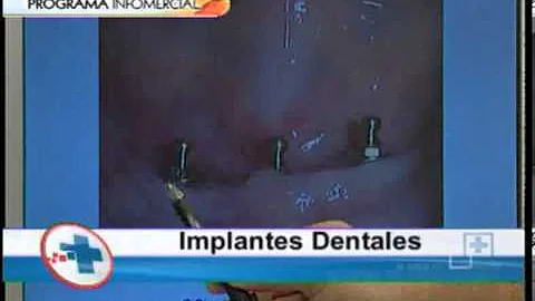 Cmo funciona una operacin de implantes dentales?
