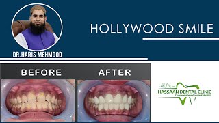 Hollywood Smile  | Hassaan Dental Clinic Rawalpindi(2022)