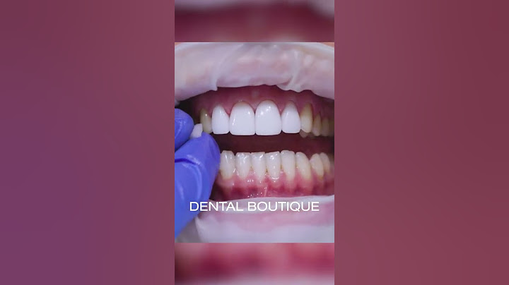 HOW SATISFYING IS THIS VENEERME PORCELAIN VENEERS INSERT?!!🥰❤️