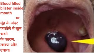 Blood filled blister inside mouth & it's sign. मुंह के अंदर खुन भरे फफोले बनने के कारण , लछण और उपाय Resimi