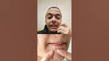 علاج حبوب الجبهة و الذقن حبوب الوجه 
