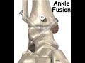 Tibiotalar arthrodesis lateral ankle arthodosis ankle arthrodesis ankle fusion