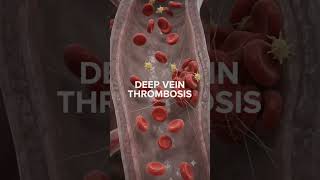 Deep Vein Thrombosis Explained in 3D | How a Blood Clot Forms in a Deep Vein