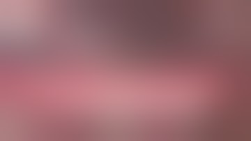 Orbit Tips 012 - Four-point IOL scleral fixation - Micropure 123 & Gore-Tex