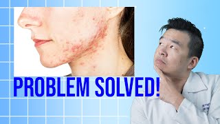 Beyond Acne: 5 Surprising Benefits of Benzoyl Peroxide Beyond Acne: 5 Surprising Benefits of Benzoyl Peroxide