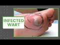 Infected Wart | Dr. Derm