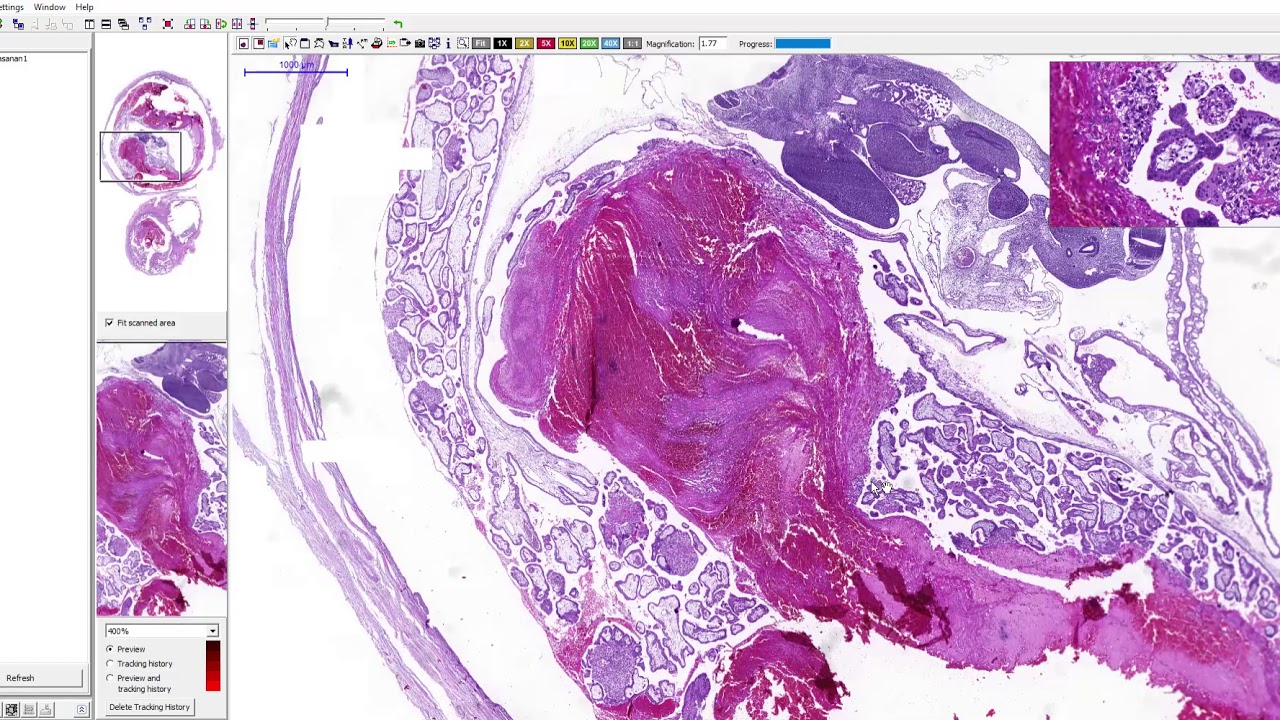 SWU Pathology: Talk Lab OB-GYN: Tubal pregnancy - YouTube