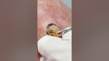 DEEP Dilated Pore of Winer | Dr. Pimple Popper #shorts #drpimplepopper #pimplepopping #pimples