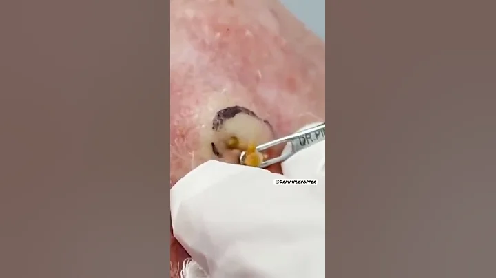 DEEP Dilated Pore of Winer | Dr. Pimple Popper #shorts #drpimplepopper #pimplepopping #pimples