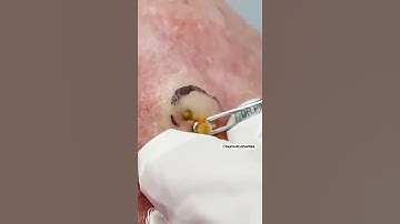 DEEP Dilated Pore of Winer | Dr. Pimple Popper #shorts #drpimplepopper #pimplepopping #pimples